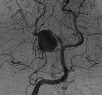 Vascular Neurosurgery